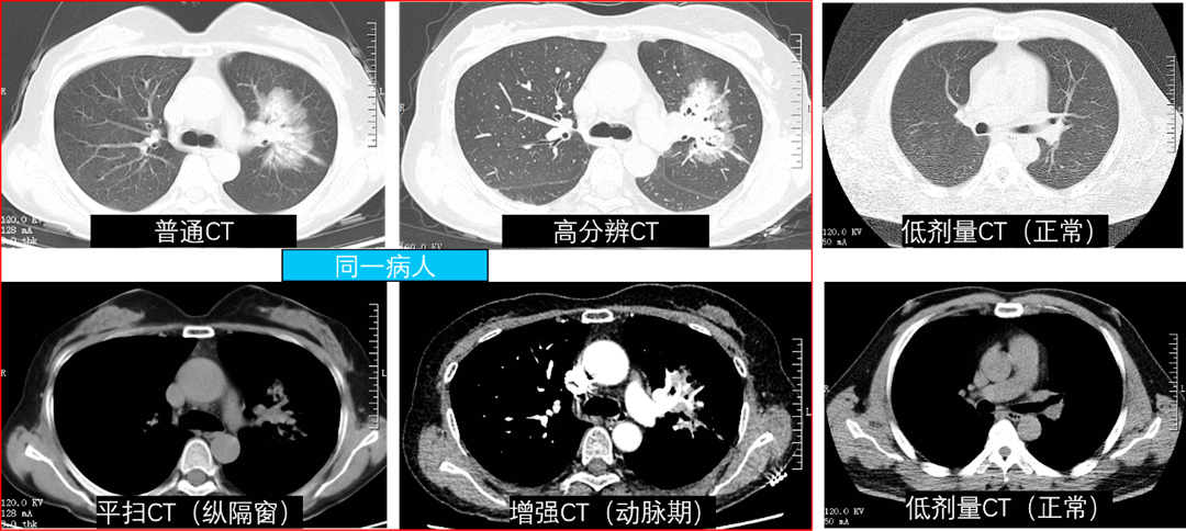 胸部检查有讲究，都叫CT啥区别？一文讲清楚_健康科普-新乡医学院第一